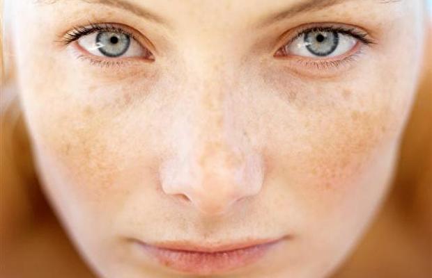 leke, leke tedavisi, leke kremi, cilt, cilt bakımı